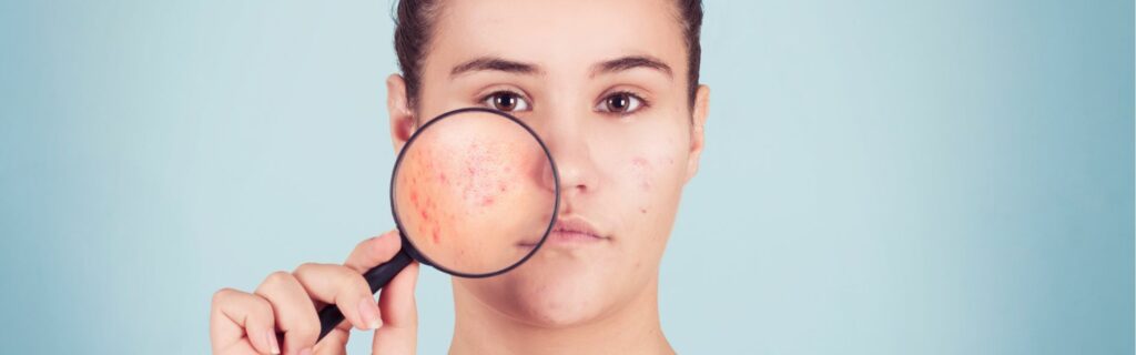 Descubre el acné y sus características
